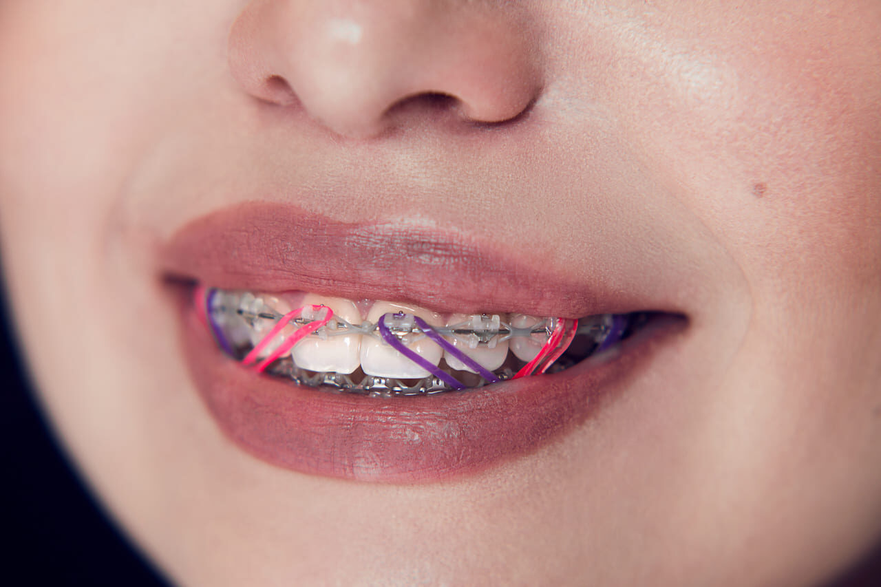 Что такое ортодонтическая тяга?